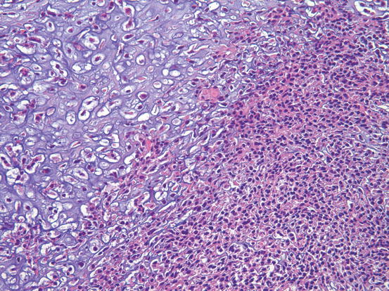 Mesenchymal Chondrosarcoma | Radiology Key