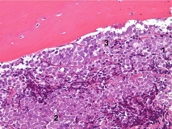 Ewing Sarcoma (ES) | Radiology Key