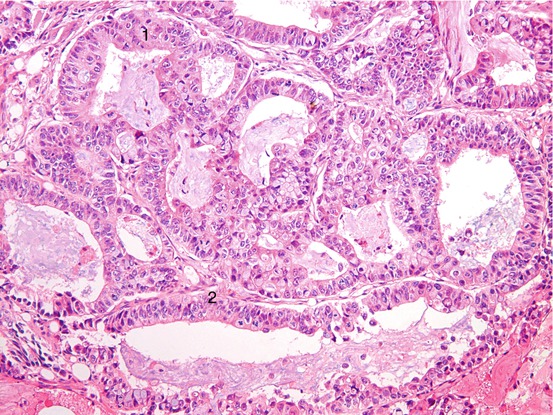 Metastatic Carcinoma | Radiology Key