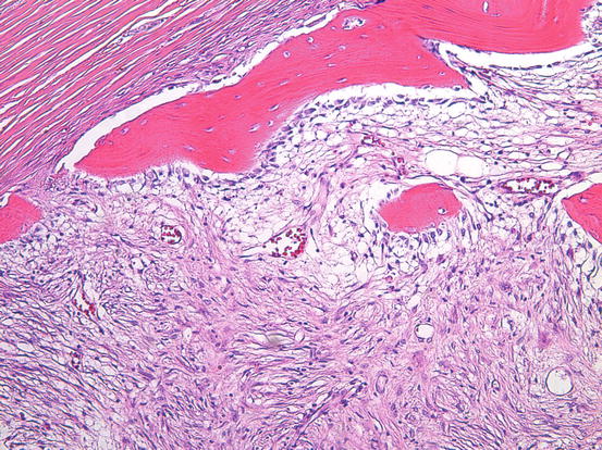 myositis-ossificans-radiology-key