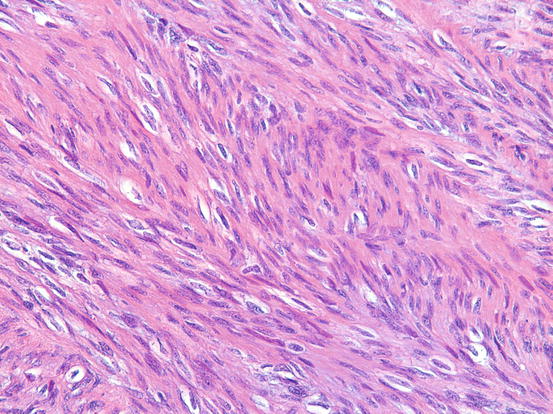 Fibrosarcoma | Radiology Key