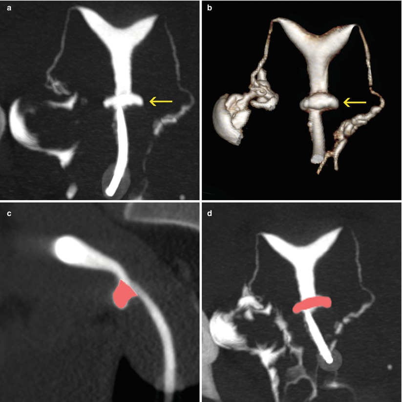 Pathology Of The Uterine Cavity Radiology Key 