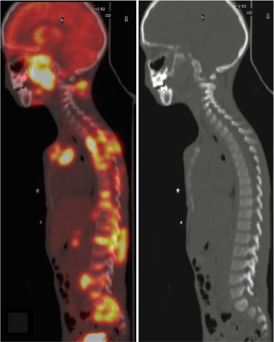 hodgkins lymphoma radiology