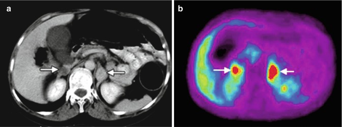 Adrenal Gland Radiology Key