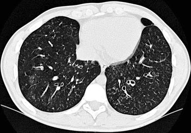 CT of the Lung in Children: Clinical Applications | Radiology Key