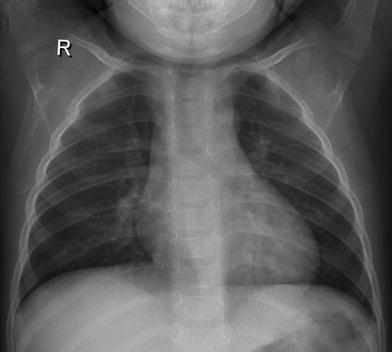 Steeple sign (trachea), Radiology Reference Article