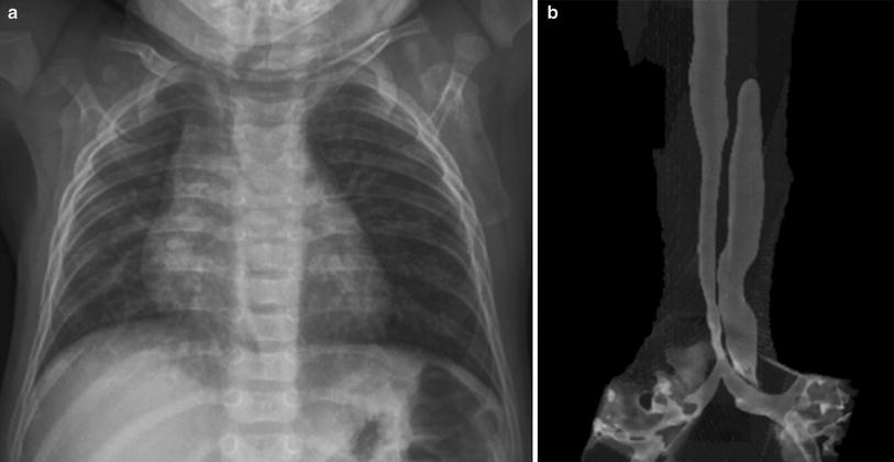 Steeple sign (trachea), Radiology Reference Article