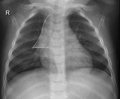 Steeple sign (trachea), Radiology Reference Article