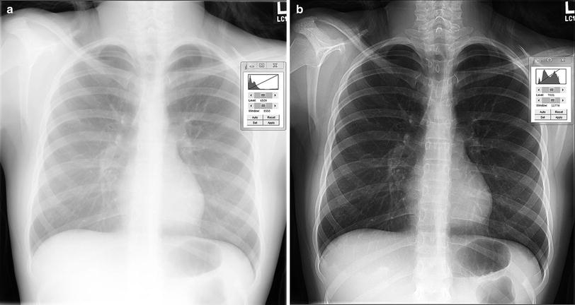 Chest X Ray Radiography