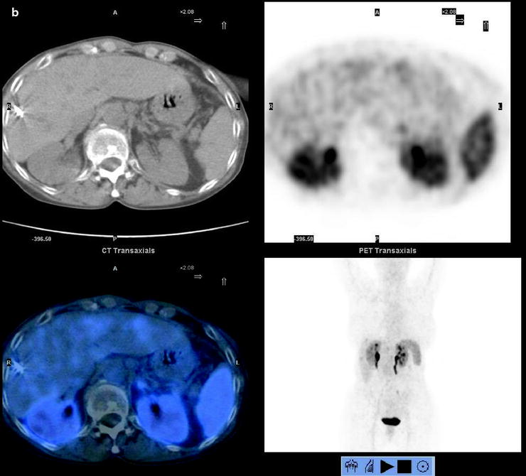 Pancreatic Cancer | Radiology Key