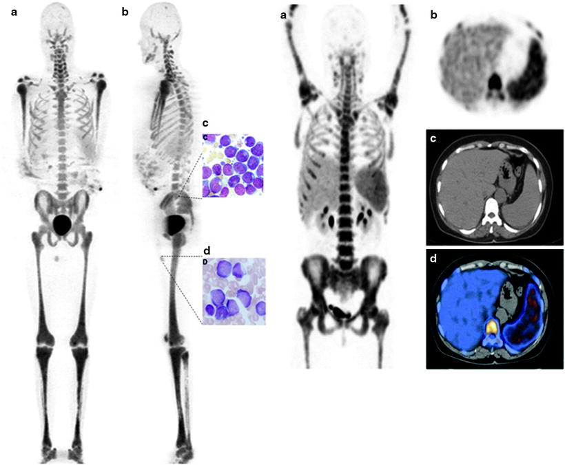 Multiple Myeloma Radiology Key 