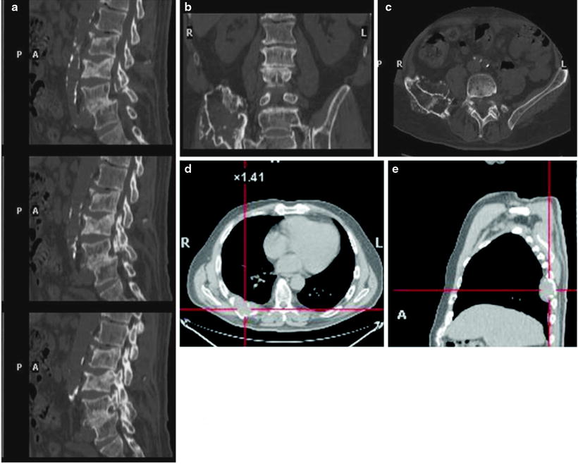 multiple myeloma x ray