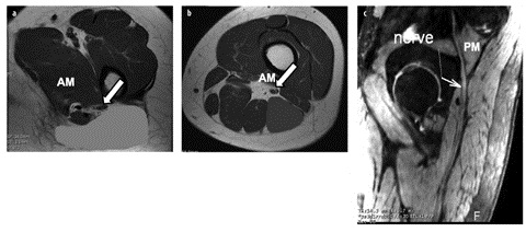 The Sciatic Nerve exits the Greater Sciatic Notch (green circle)