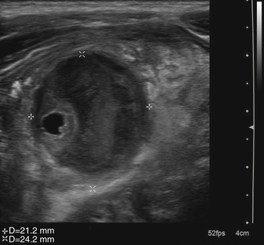 Neonatal Spinal Dimple | Radiology Key