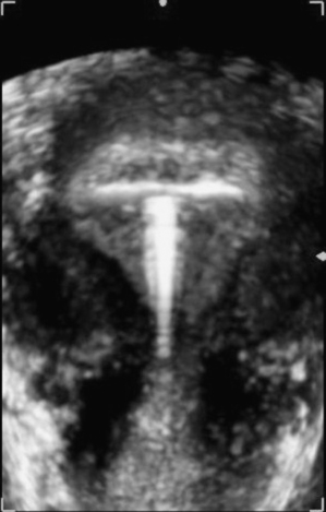 paragard iud ultrasound