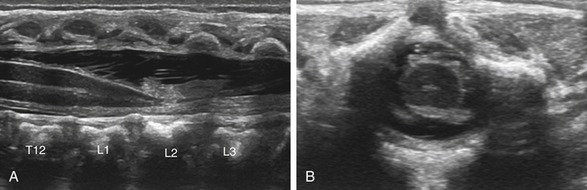 sacral dimple ultrasound