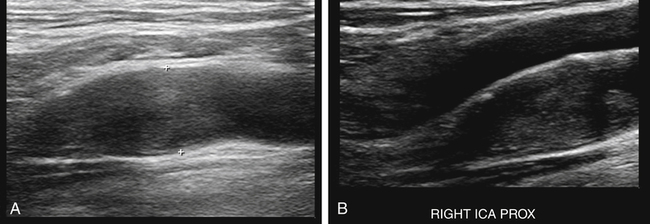 Neonatal Spinal Dimple | Radiology Key