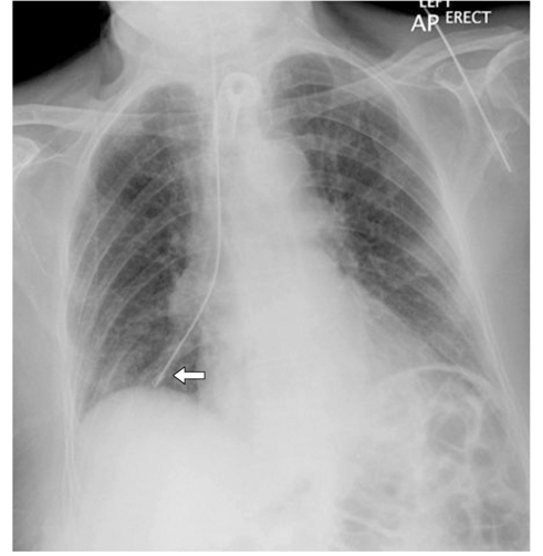 Nasogastric Tubes 