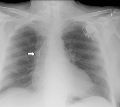 Permanent pacemakers | Radiology Key