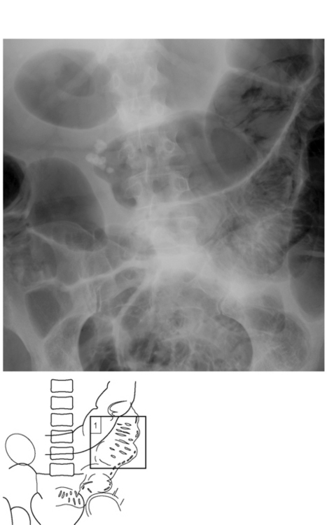Pneumatosis intestinalis | Radiology Key