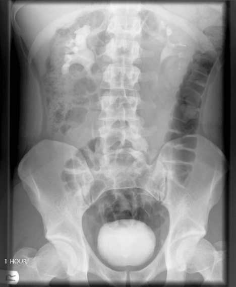 Imaging Of Urinary Tract Calculi | Radiology Key