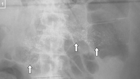 Chronic Pancreatitis Radiology Key