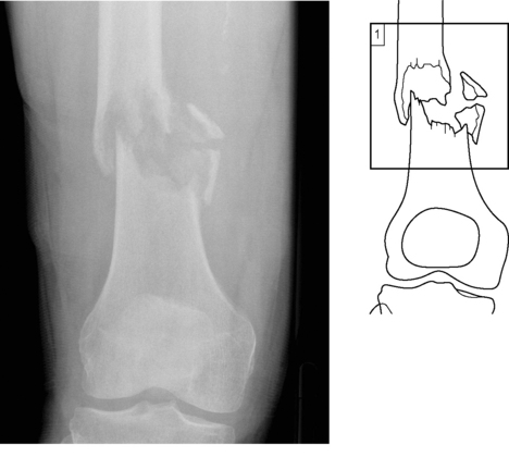 unspecified pathological fracture presence m81.0