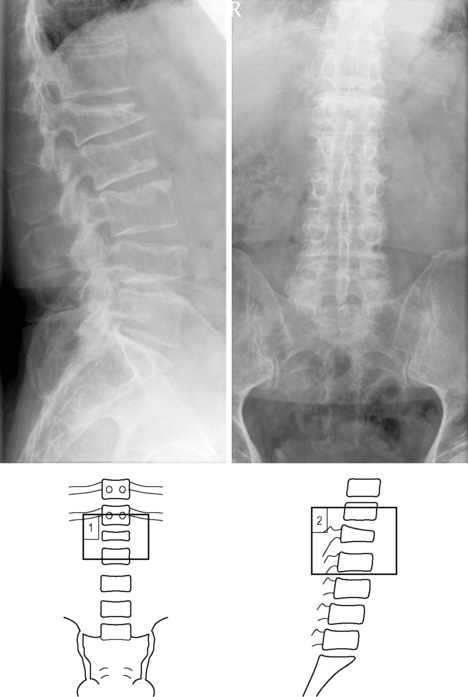 The correlation between vertebral wedge-shaped changes in X-ray imaging at  supine and standing positions and the efficacy of operative treatment of  thoracolumbar spinal fracture in the elderly