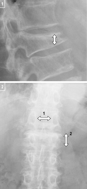 wedge in spine