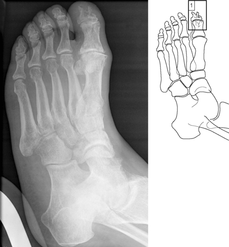 Osteomyelitis Foot Osteomyelitis Foot