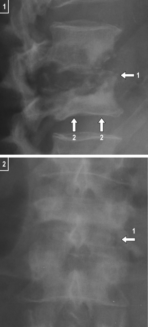 Discitis | Radiology Key