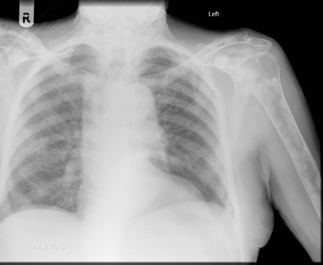 Bone Metastases Images and Xrays