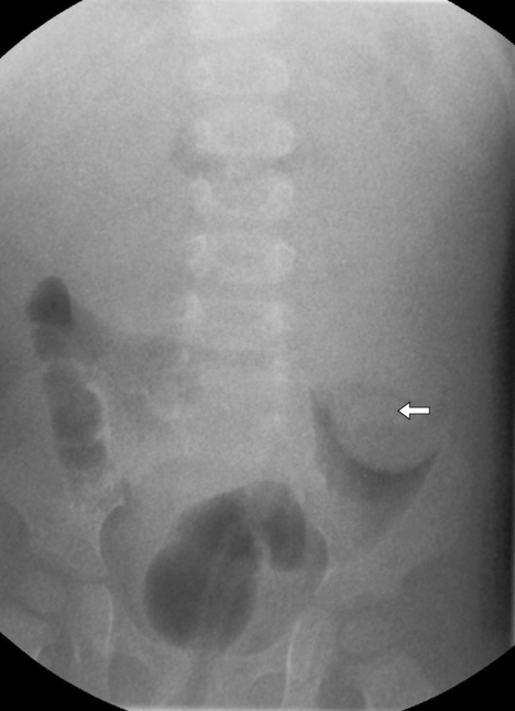 intussusception crescent sign
