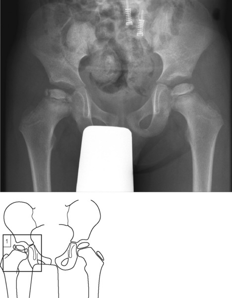 Perthes’ disease | Radiology Key