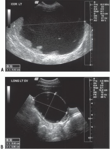 Pelvic Ultrasound In The Nongravid Patient | Radiology Key