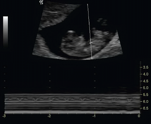 First Trimester Pregnancy | Radiology Key