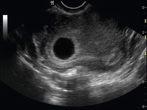 Empty Sac In Early Pregnancy Small Gestational Sac Sac Size In Early 