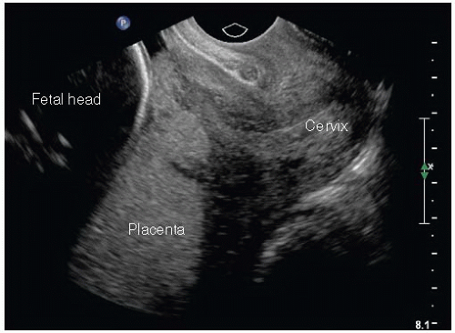 Trimester ultrasound second Pregnancy Ultrasound
