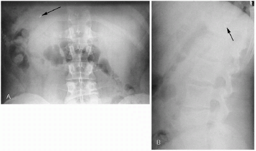 Radiographic Artifacts Radiology Key