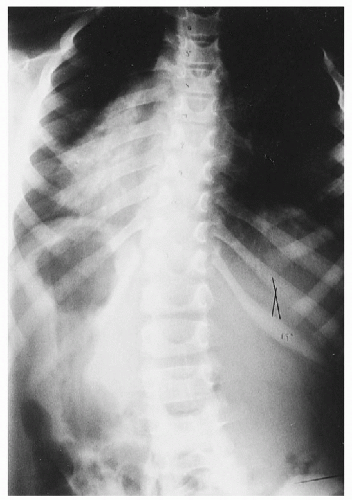 Scoliosis | Radiology Key