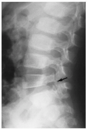 Lateral listhesis lumbar spine - frankensteincoursework.x.fc2.com