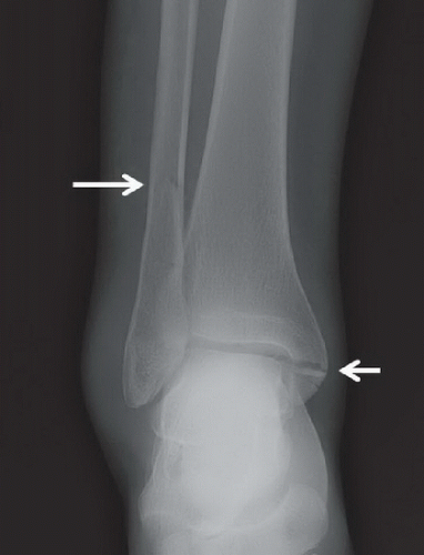 Trimalleolar Ankle Fracture | Radiology Key