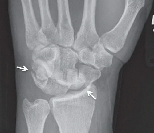 Perilunate Dislocation | Radiology Key