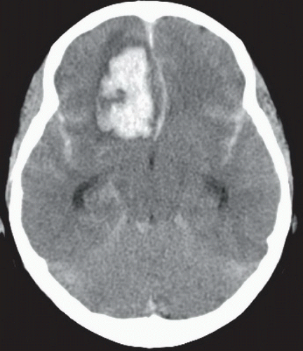 Aneurysmal Subarachnoid Hemorrhage Radiology Key