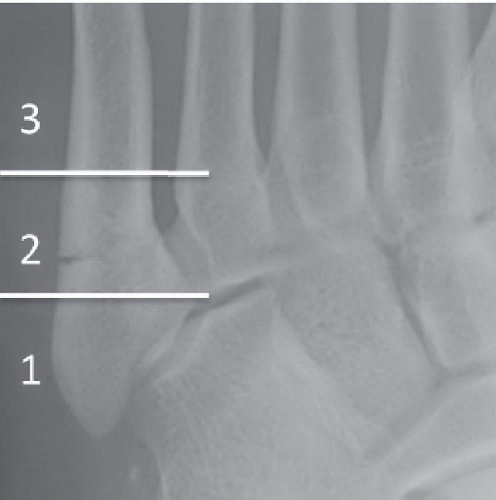 base of fifth metatarsal fracture