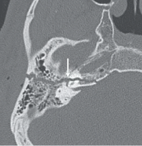 Longitudinal Temporal Bone Fractures Radiology Case R - vrogue.co