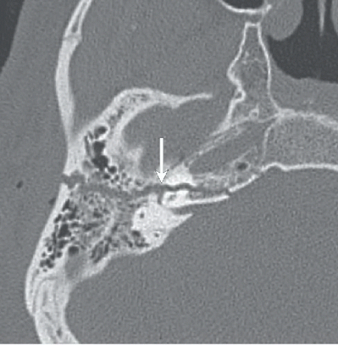 Temporal Bone Fracture Radiology Key