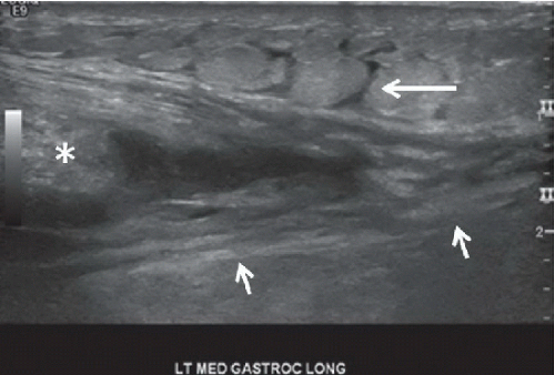 Medial Head of Gastrocnemius Muscle Tear | Radiology Key