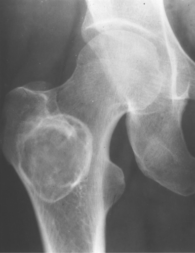 Benign Cystic Bone Lesions Radiology Key