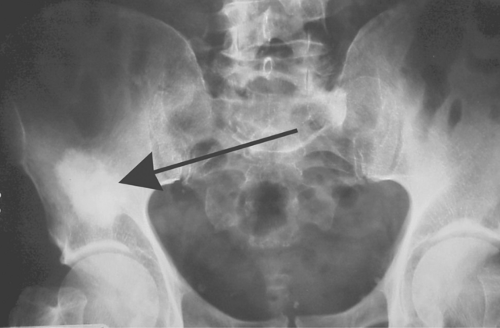 Benign Cystic Bone Lesions Radiology Key